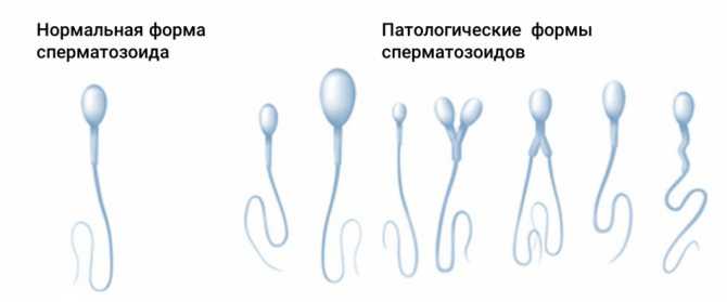 Патологические формы в спермограмме. дефект головки сперматозоида — что делать при аномалии головки спермия. тератозооспермия: лечение народными средствами