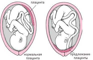 Положение плаценты по отношению к внутреннему зеву