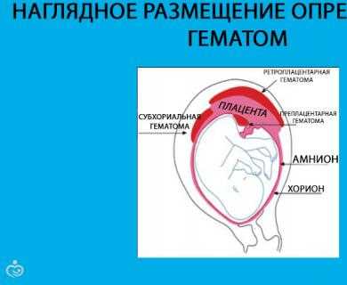 Гематома при беременности на ранних сроках: причины кровотечения, последствия, лечение | kvd9spb.ru