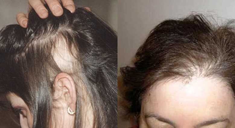 Выпадают волосы после родов - причины, лечение и что делать