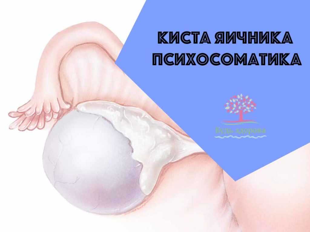 Поликистоз яичников (спкя): симптомы, причины, лечение
