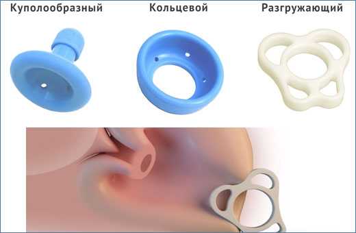 Акушерский пессарий при беременности (35 фото): что это такое, когда снимают разгружающий пессарий, установка, отзывы