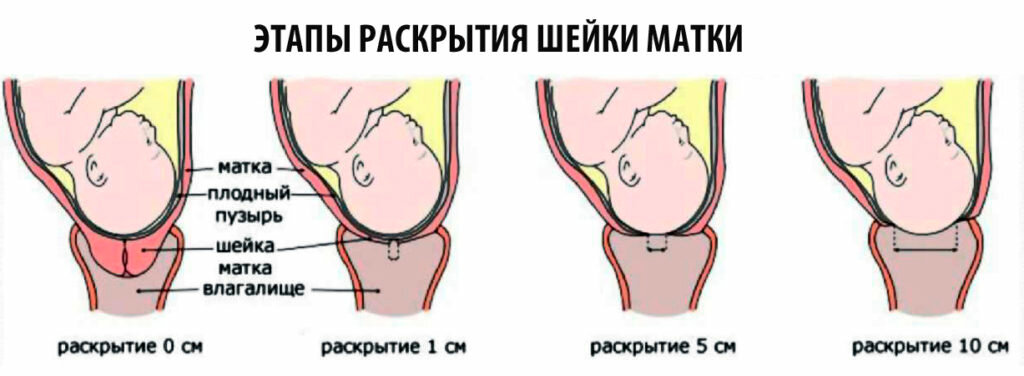 Катетер фолея для раскрытия шейки матки через сколько начнутся роды. horoshayaberemennost.ru