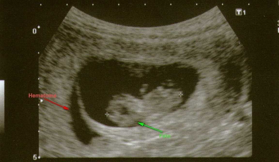 Гематома при беременности на ранних сроках (23 фото): причины и лечение ретрохориальной и субхориальной форм в матке, как и когда выходит