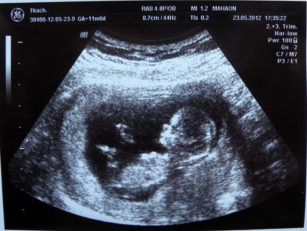11 неделя беременности: что происходит с малышом и мамой, фото, развитие плода, ощущения