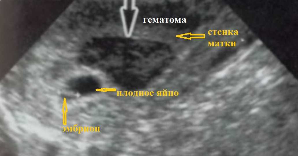 Диагностика и лечение ретрохориальной гематомы у беременных