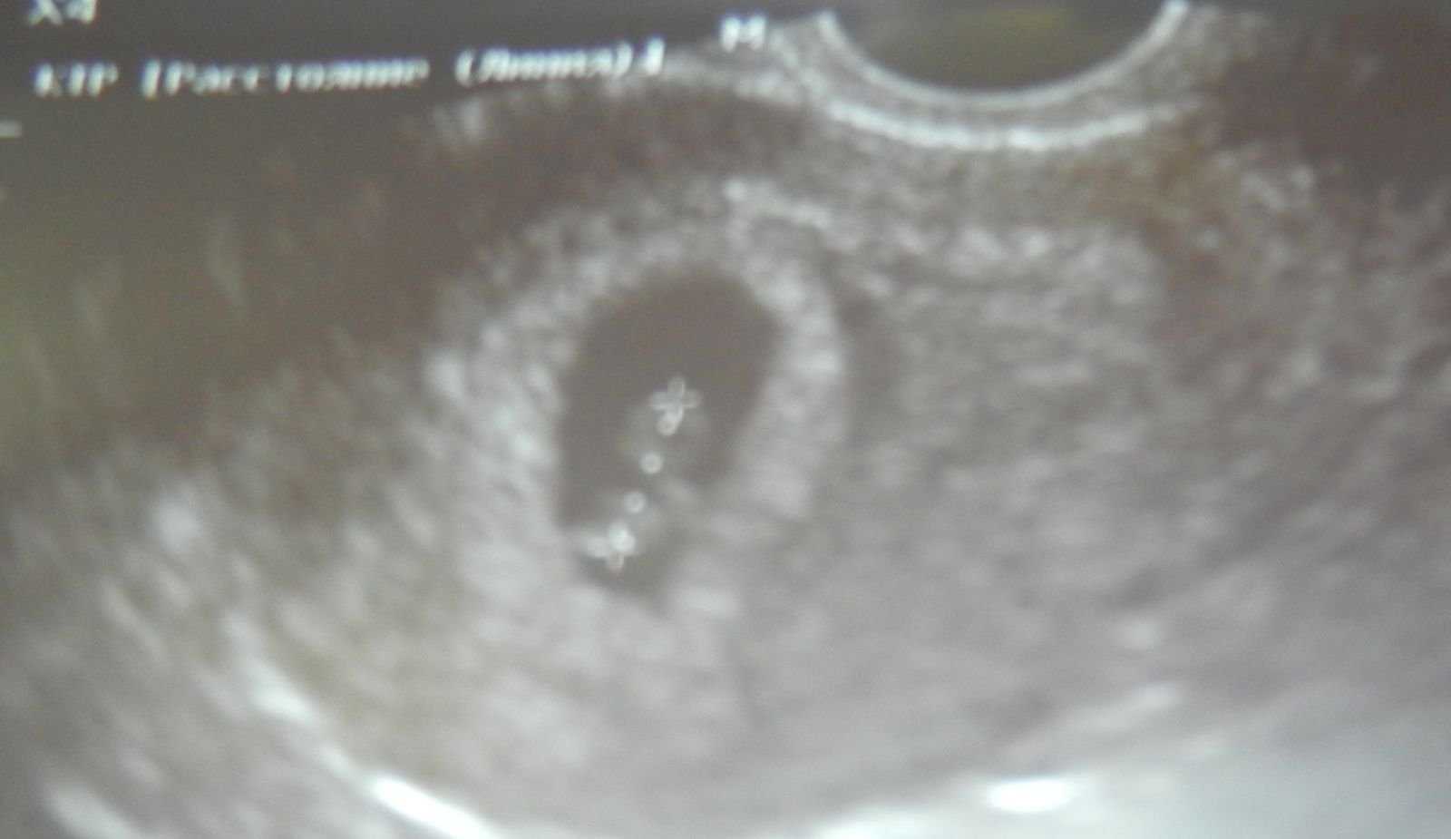 Как выглядит зародыш на 4 неделе беременности фото
