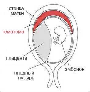 Почему гематома при беременности