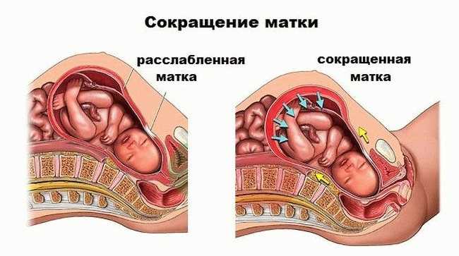 Тонус матки при беременности 3 триместр: симптомы, причины, особенности по неделям (28,29,30,31,32,33,34,35,36,37,38,39,40,41 неделе) | vrachmatki