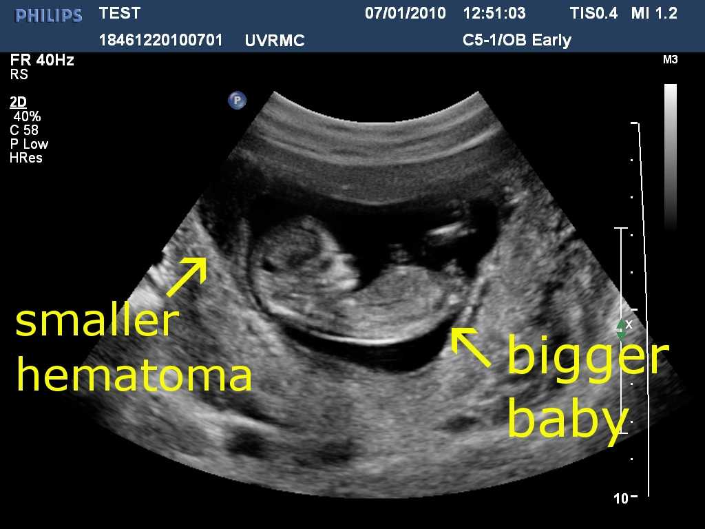 Ретрохориальная гематома при беременности: последствия для ребенка, причины, диагностика и лечение