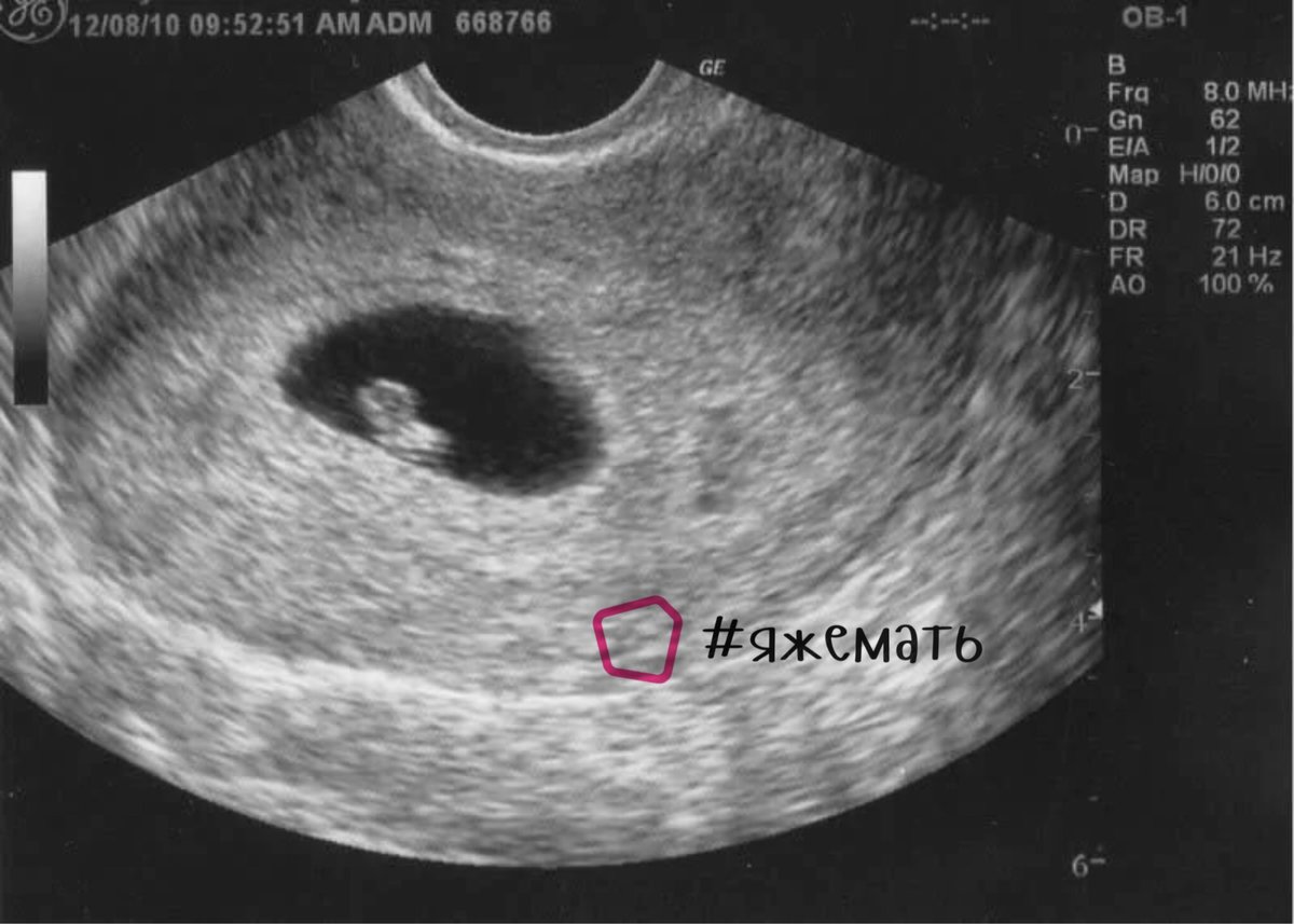 5 неделя беременности: развитие эмбриона, ощущения женщины ~ блог о детях