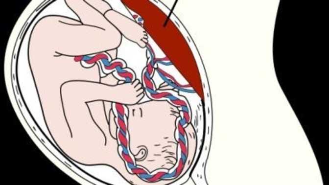 Краевое прикрепление пуповины к плаценте - почему возникает и чем опасно | азбука родов | яндекс дзен
