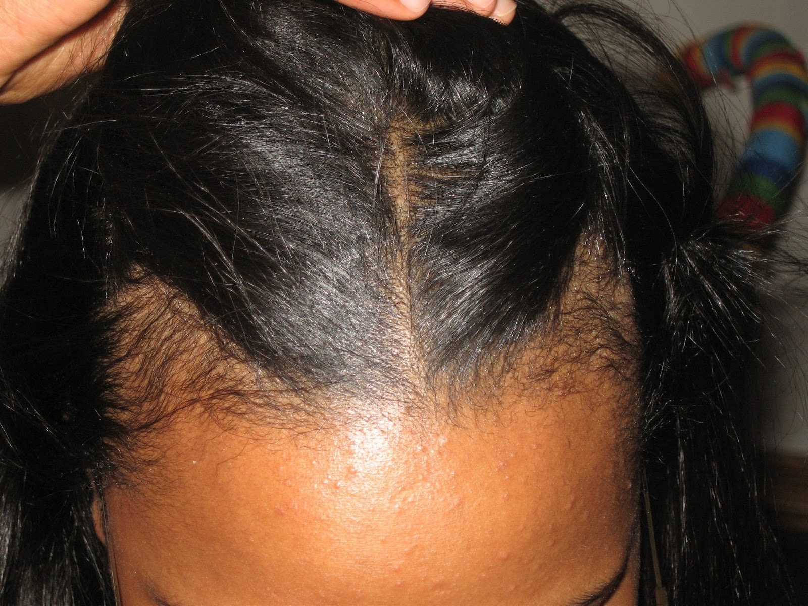 Что делать, если сильно выпадают волосы после родов: причины и лечение