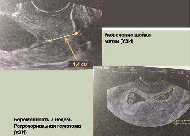Ретрохориальная гематома при беременности: последствия для ребенка, причины, диагностика и лечение