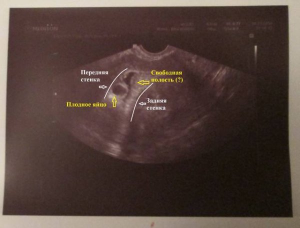 Гематома при беременности на ранних сроках: как выглядит заоболочечная на узи, почему появляется, и как долго она выходит, медикаментозное лечение ретрохориальной гематомы