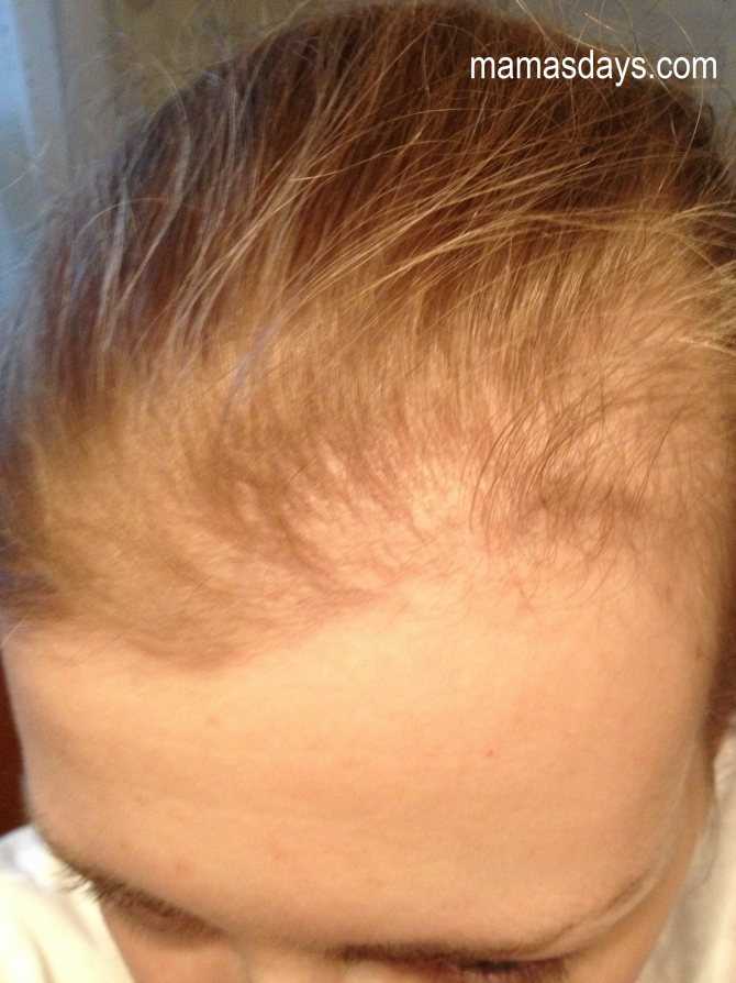 Выпадение волос после родов, причины, что делать, рецепты лечебных масок
