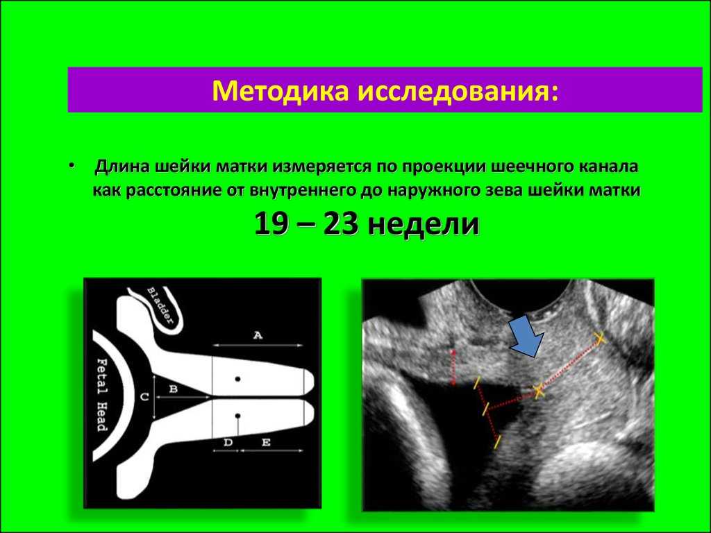 Длина шейки в 20 недель. 38 Мм шейка матки при беременности норма. Длина шейки матки. Измерение шейки матки при беременности. Длина сомкнутой части шейки матки.