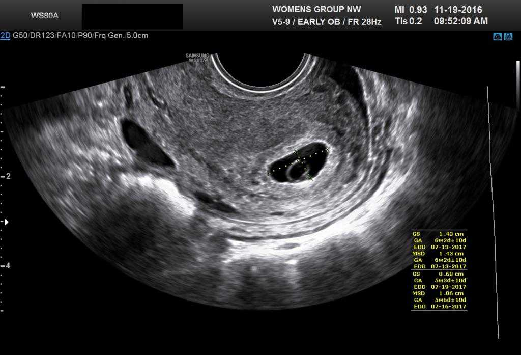 Узи в 2 недели беременности после зачатия: покажет ли, как выглядит плод (фото) и что видно, кому назначают, подготовка и проведение исследования