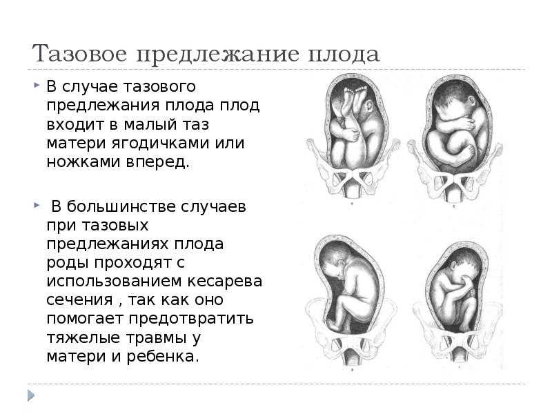 Беременность и где расположен ребенок: положение плода при беременности - головное, тазовое, поперечное и косое предлежание плода • твоя семья - информационный семейный портал