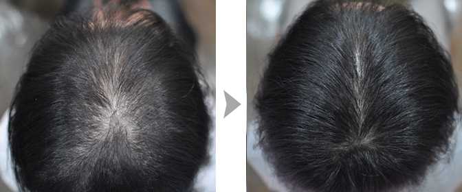 Почему после родов выпадают волосы? как эффективно устранить эту проблему?