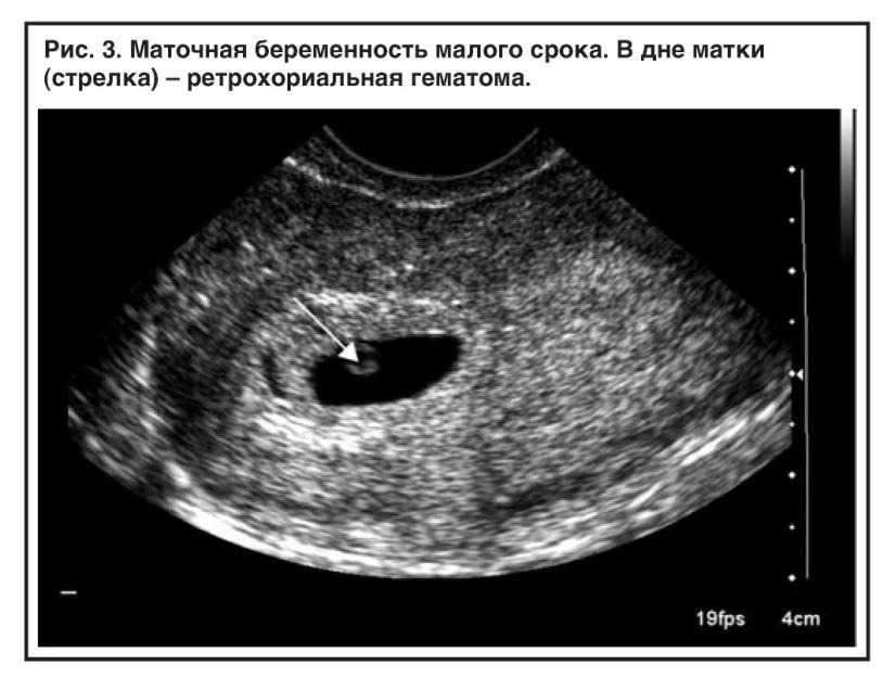 Субамниотическая гематома при беременности newmed.su - все для мамы и малыша
