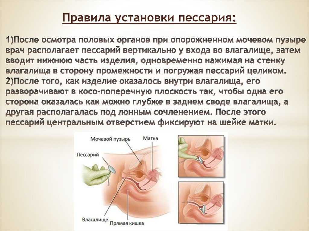 Акушерский пессарий при беременности: виды, причины установки, противопоказания