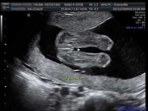 Узи на 20 неделе беременности (30 фото): размер плода, показатели и норма, параметры – таблица, определение пола, расшифровка
