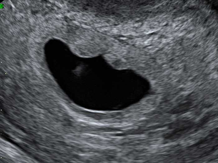Гематома при беременности на ранних сроках: причины и симптомы, как гематома выходит и чем она опасна для беременной и плода