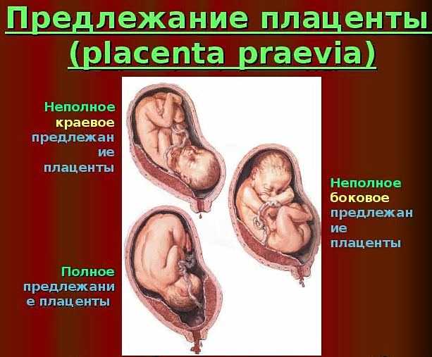 Предлежание плаценты