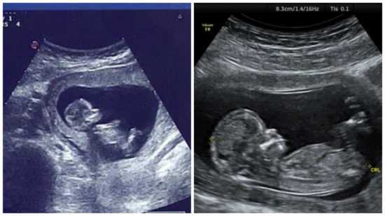 Кости в 13 недель. УЗИ В 12 недель беременности пол ребенка. УЗИ 12 недель беременности скрининг девочка. Пол плода на 12 неделе беременности по УЗИ. УЗИ на 13 неделе беременности скрининг пол ребенка.