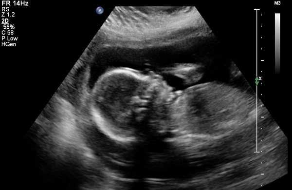 Узи в 12 недель беременности: таблица нормы и размеров плода, что показывает исследование и как выглядит ребенок, какие патологии выявляют и что смотрят