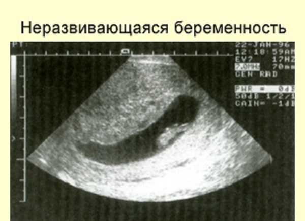 Фото плодного яйца после медикаментозного прерывания беременности