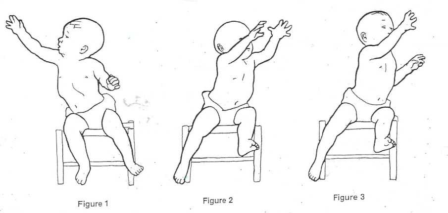 Упражнения при воронкообразной деформации грудной клетки у детей - ортопедапомощь