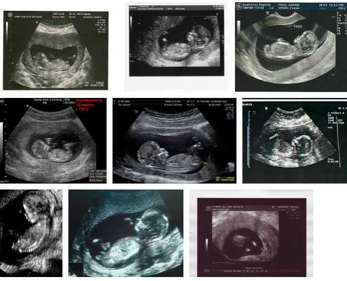 Скрининг 2 триместра (39 фото): сроки проведения второго узи при беременности, что это такое и что смотрят, нормы и расшифровка результатов