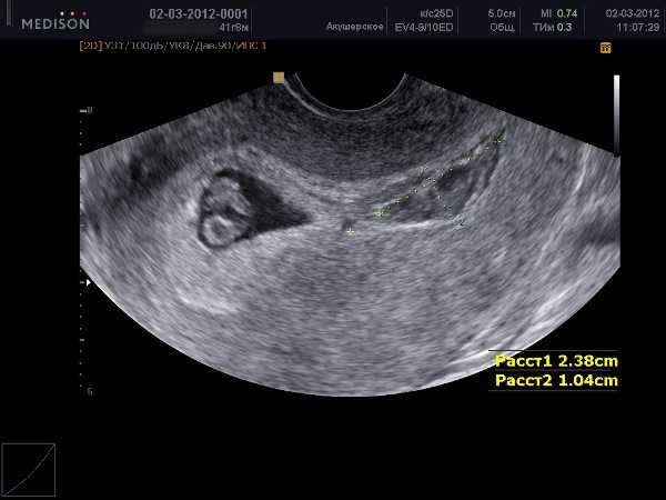 Гематома в матке (ретрохориальная и прочие) при беременности на ранних сроках: причины, симптомы, лечение