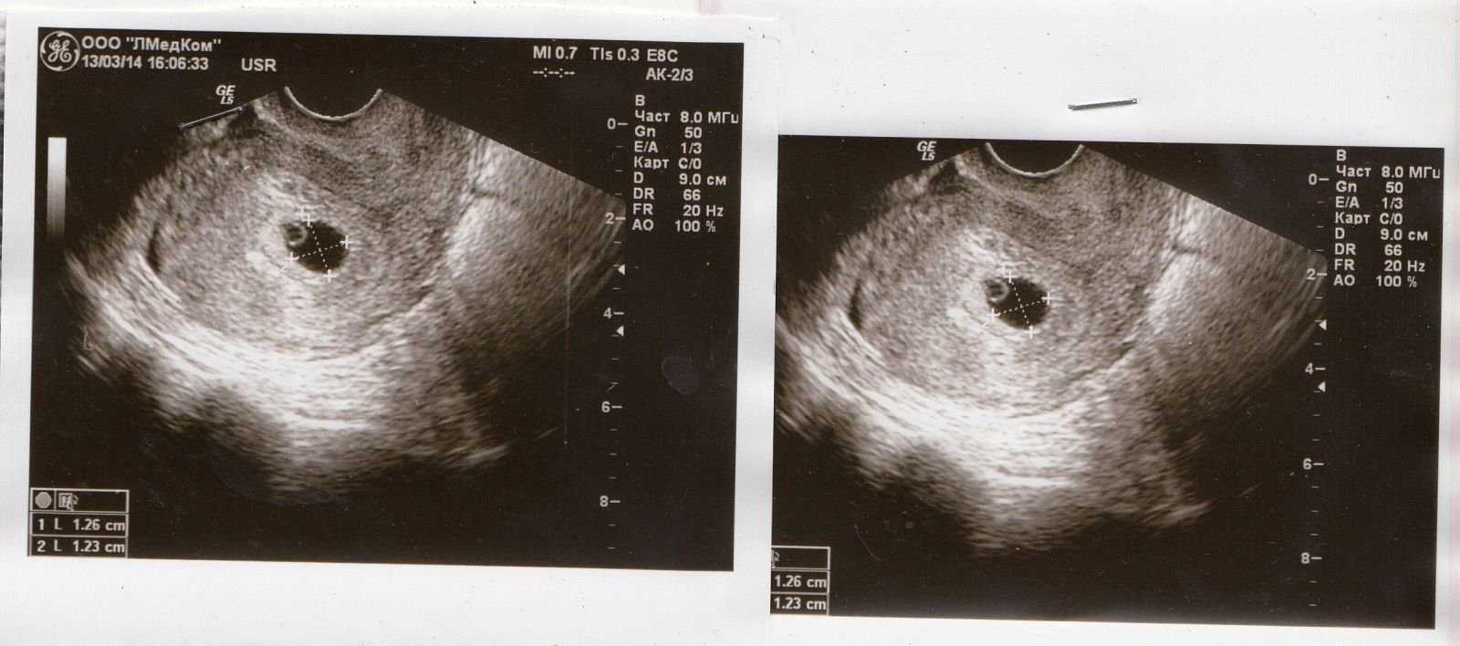 Узи на 7 неделе беременности (25 фото) размер плода и малого таза, что показывает, особенности эмбрионов-двойни