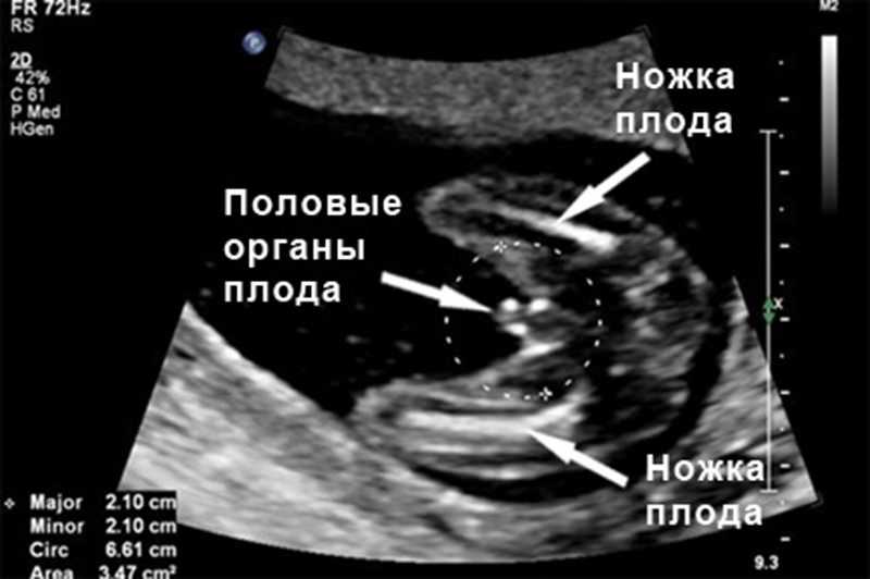 15 недель беременности узнать пол