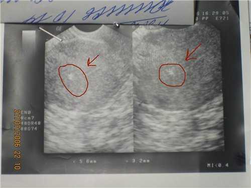 9 недель беременности – живот и выделения (23 фото): коричневые, желтые или кровянистые выделения, ощущения – тянет низ живота