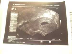 Развитие плода на 10 неделе беременности (27 фото): что происходит с малышом, размер ребенка и ощущения, как выглядит эмбрион на 10 акушерской неделе