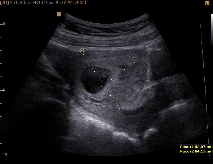 Матка 12 мм. Ретрохориальная гематома беременность. Ретрохориальная гематома на УЗИ. Ретрохориальная гематома при беременности на 12 неделе беременности. Ретроамниальная гематома на УЗИ.