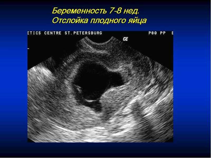 Причины образования ретроамниотической, подоболочечной или заоболочечной гематомы на теле матки при беременности, и можно ли ее вылечить без рисков для ребенка