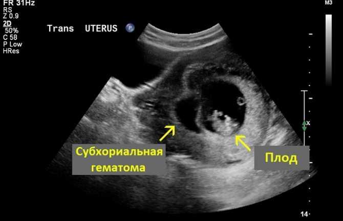 Гематома при беременности | симптомы и лечение гематомы при беременности | компетентно о здоровье на ilive