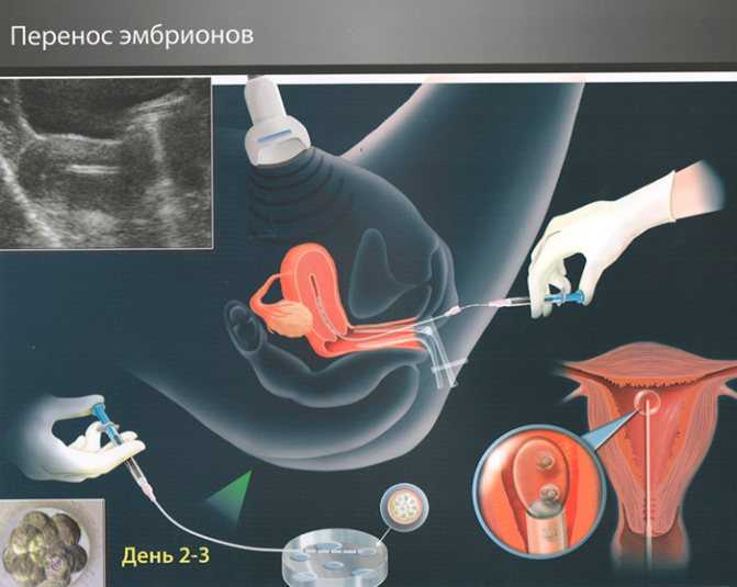 Тянет низ живота после переноса эмбрионов: полное описание, причины, советы и рекомендации