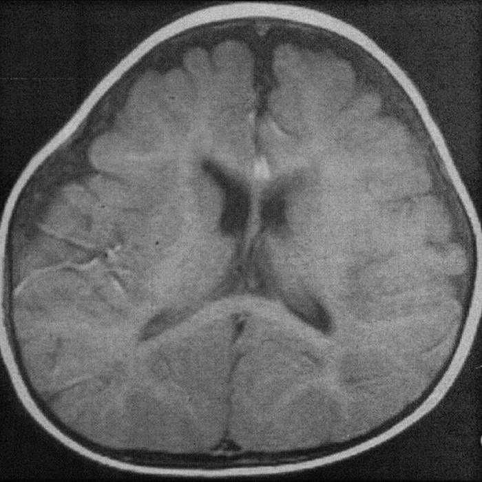 Водянка (гидроцефалия) головного мозга у младенцев: причины заболевания и способы медицинского вмешательства