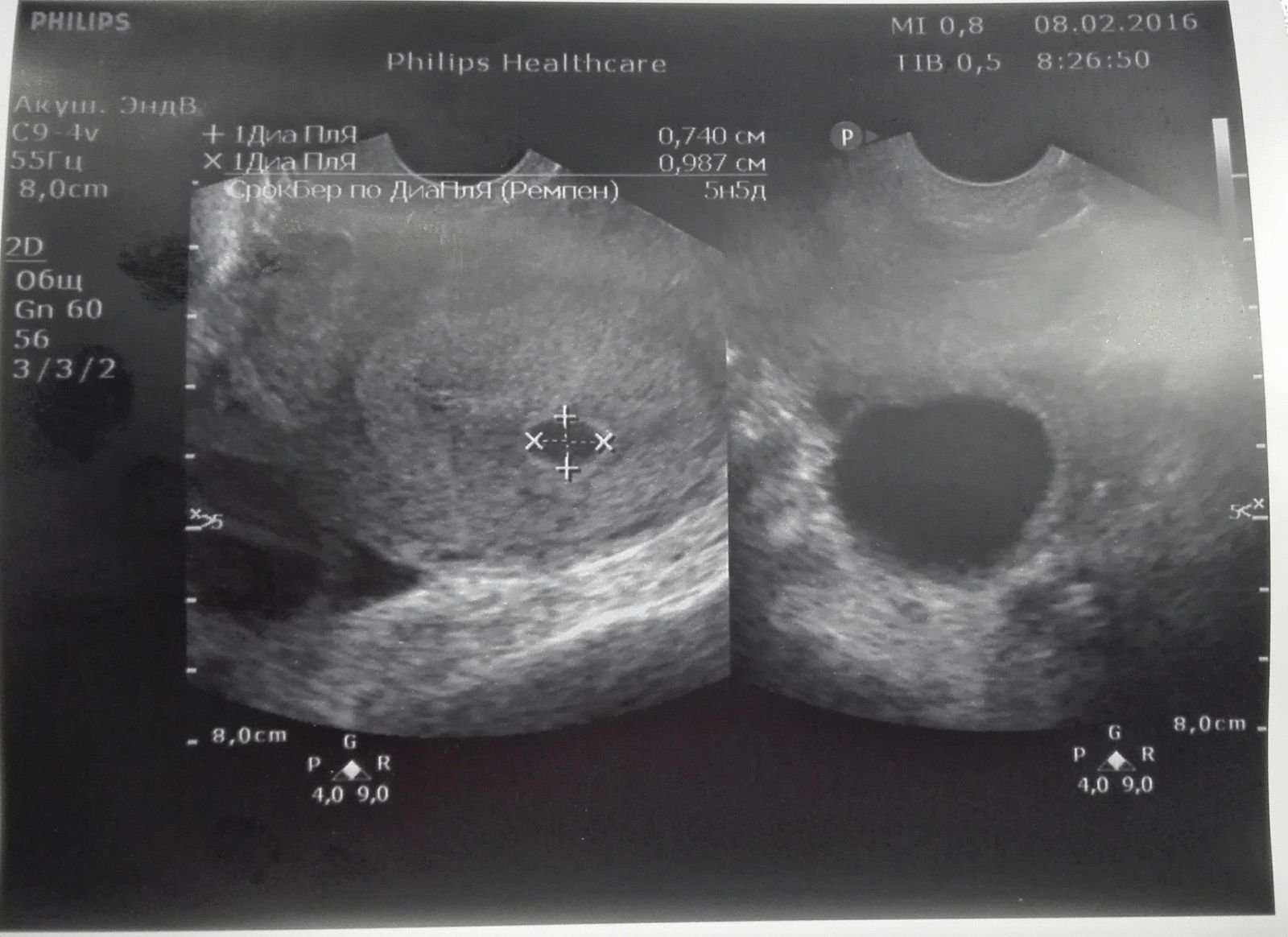 Узи на 7 неделе беременности (25 фото) размер плода и малого таза, что показывает, особенности эмбрионов-двойни