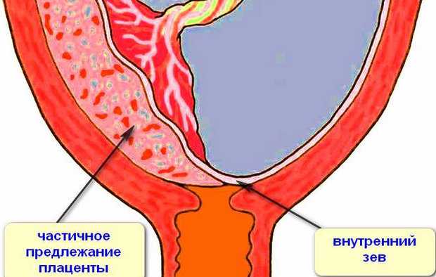 Краевое предлежание хориона: что это, положение плаценты по передней стенке матки, как влияет на плод и может ли перейти в другое положение