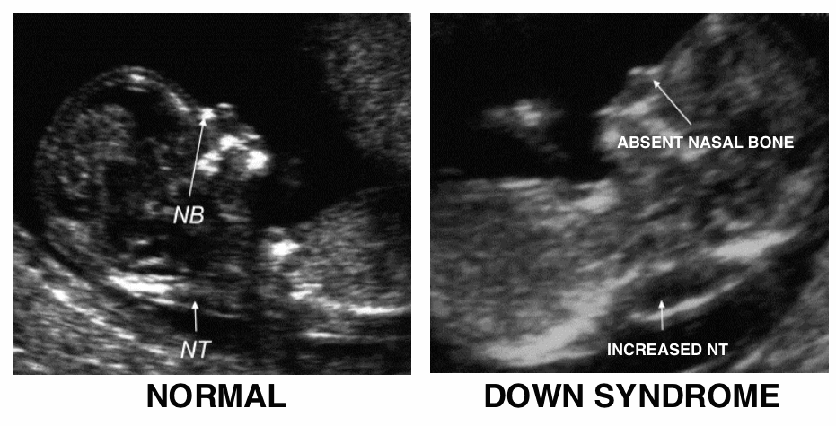Фото Узи Плода С Синдромом Дауна