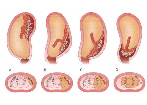 Плацента расположена по передней стенке матки: причины и осложнения