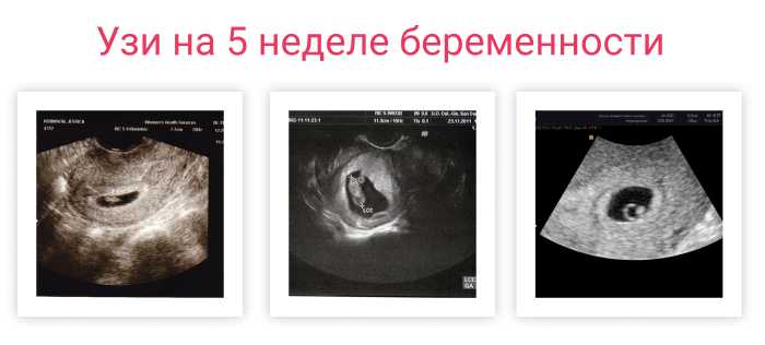 Выделения при беременности на ранних и поздних сроках (41 фото): какими должны быть в норме и до задержки