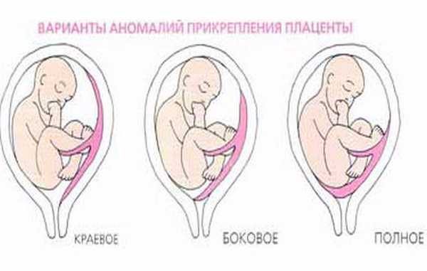 13 неделе беременности плацента. Краевое предлежание плода на 12 неделе беременности. Плацента перекрывает внутренний зев. Предлежание плаценты при беременности. Хорион перекрывает внутренний зев.